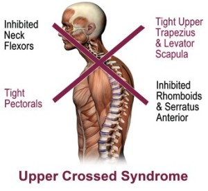 upper-crossed-syndrome